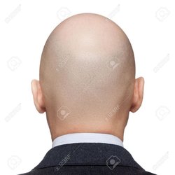 13175100-Humanos-alopecia-o-ca-da-del-cabello-posterior-adulto-hombre-calvo-o-Vista-posterior-de.jpg